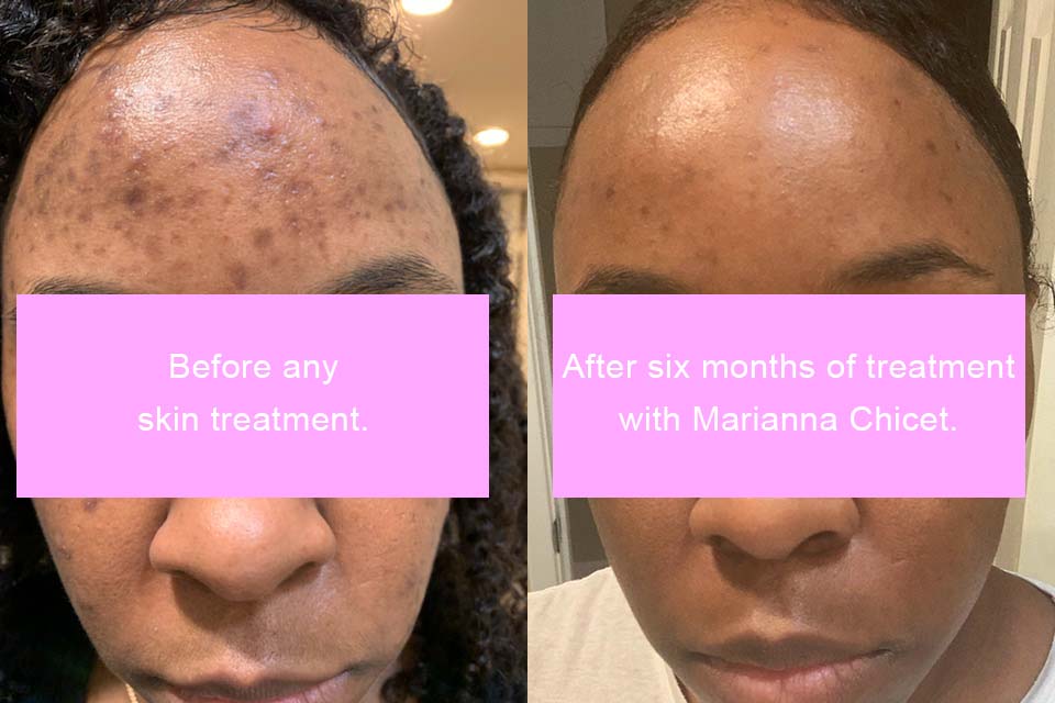 Before/After of six months of skincare treatment with Marianna Chicet, exhibiting a client with significantly smoother skin and less acne.
